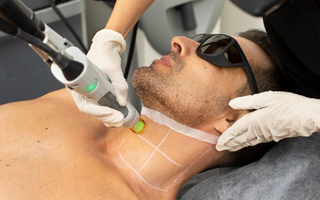 Unlock Silky Smooth Skin with Laser Hair Removal
