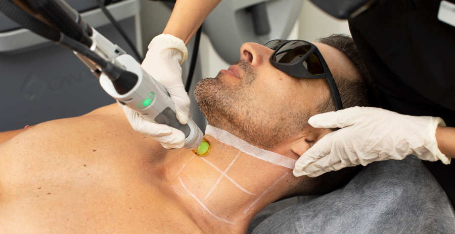 MALE LASER HAIR REMOVAL