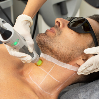 MALE LASER HAIR REMOVAL