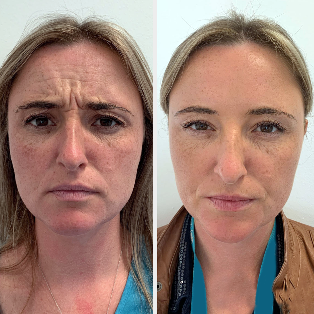 ANTI-WRINKLE INJECTIONS