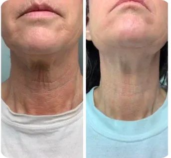 SKIN NEEDLING NECK