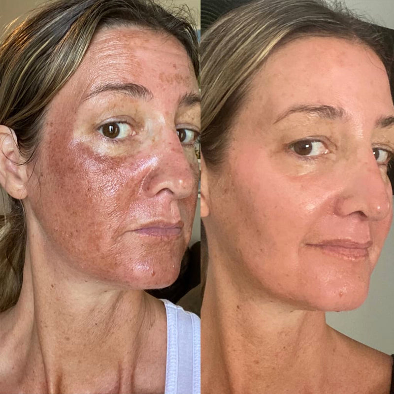 PIGMENTATION PEEL