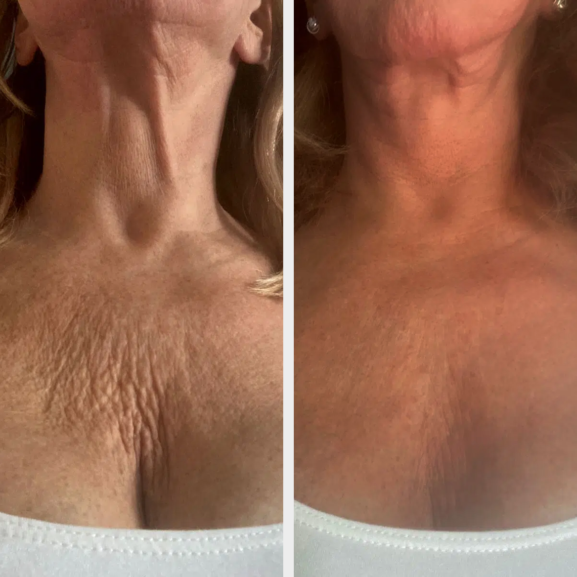 ADD DERMAPEN4 - DECOLLETAGE