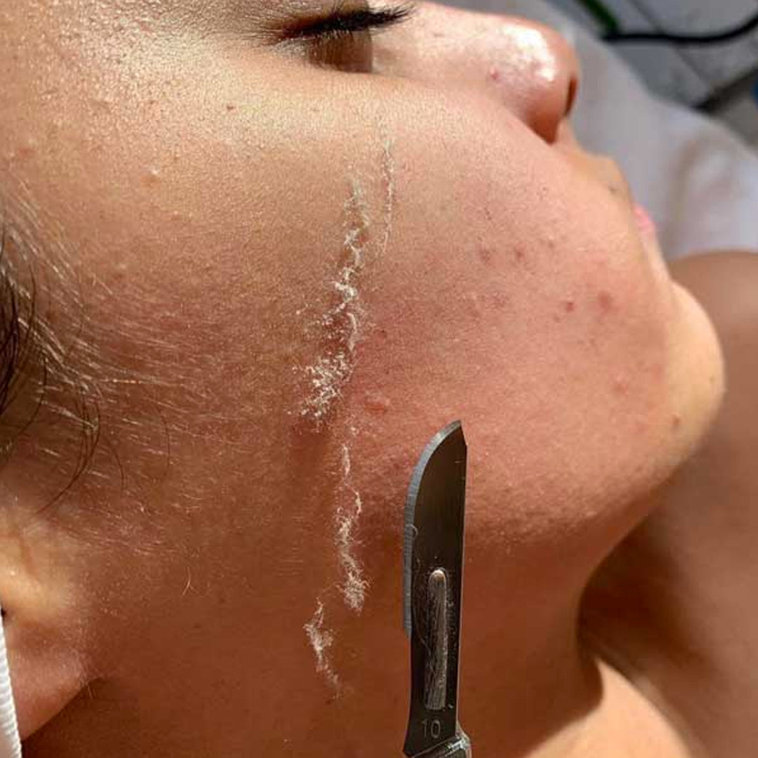 DERMAPLANING