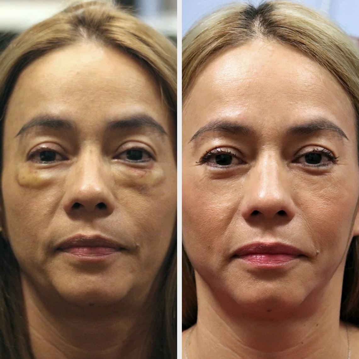 DERMA FILLERS