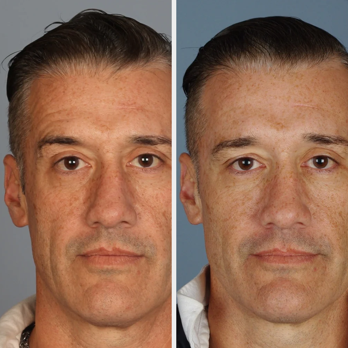 DERMA FILLERS