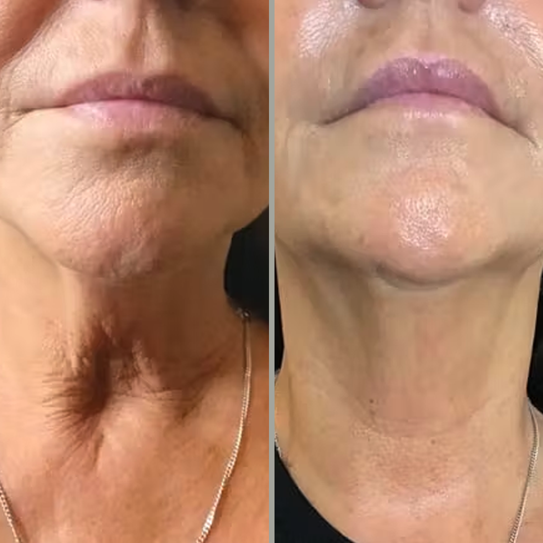 HIFU NON-SURGICAL NECK LIFT