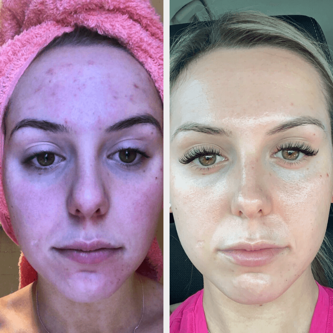 LED LIGHT THERAPY FACIAL