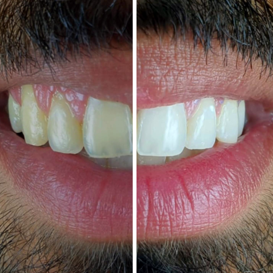 ADVANCED TEETH WHITENING